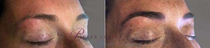 Nonsurgical Face Procedures Case 335 Before & After View #1 | Paramus, NJ | Parker Center for Plastic Surgery