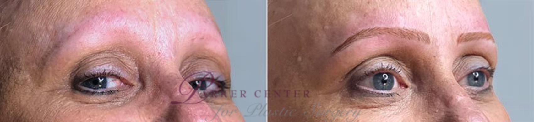 Nonsurgical Face Procedures Case 337 Before & After View #1 | Paramus, NJ | Parker Center for Plastic Surgery