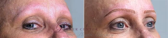 Nonsurgical Face Procedures Case 337 Before & After View #1 | Paramus, NJ | Parker Center for Plastic Surgery