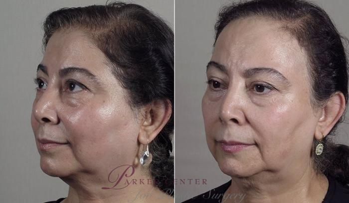Nonsurgical Face Procedures Case 344 Before & After View #2 | Paramus, NJ | Parker Center for Plastic Surgery