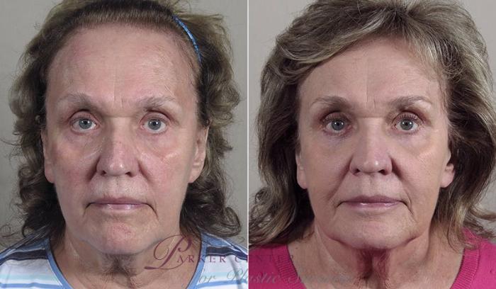 Nonsurgical Face Procedures Case 345 Before & After View #1 | Paramus, NJ | Parker Center for Plastic Surgery