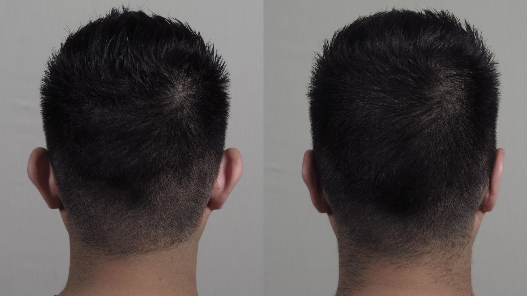 Otoplasty Case 1018 Before & After Back | Paramus, NJ | Parker Center for Plastic Surgery