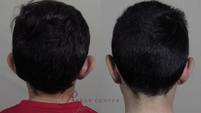 Ear Surgery Case 1020 Before & After Back | Paramus, NJ | Parker Center for Plastic Surgery