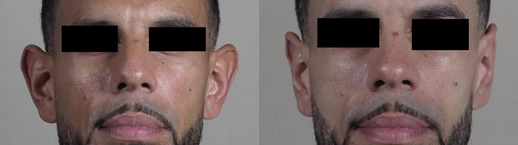 Otoplasty Case 1096 Before & After Front | Paramus, New Jersey | Parker Center for Plastic Surgery