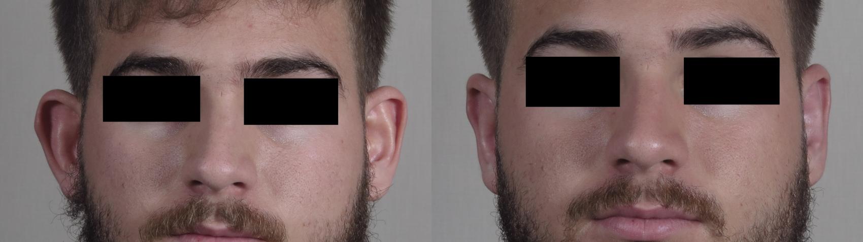 otoplasty before after