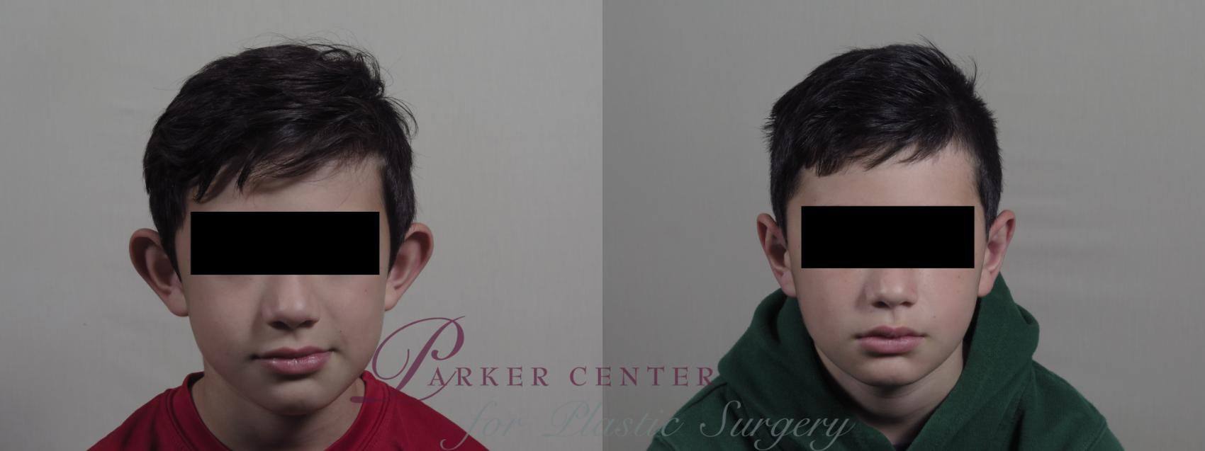 Otoplasty Case 1205 Before & After View #1  | Paramus, NJ | Parker Center for Plastic Surgery
