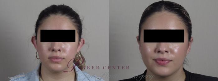 Otoplasty Case 1208 Before & After View #1  | Paramus, NJ | Parker Center for Plastic Surgery