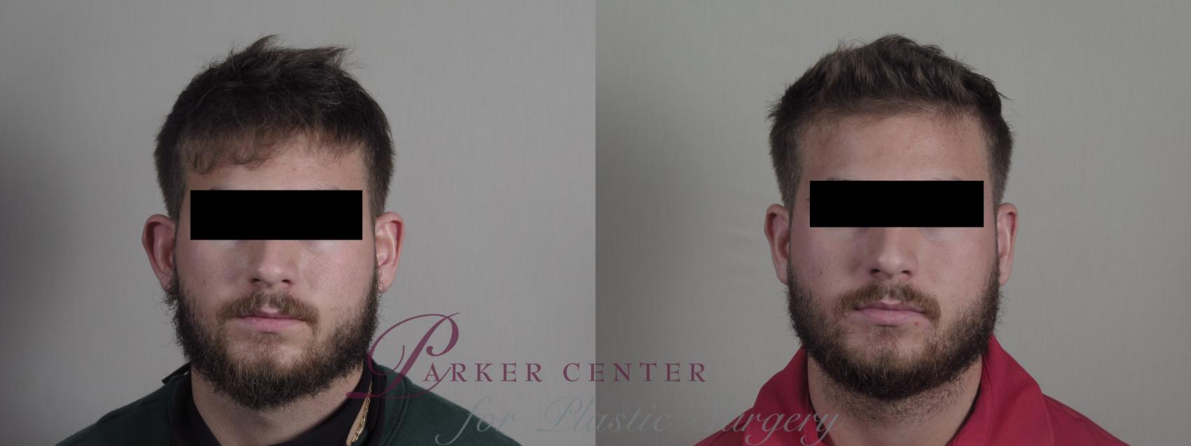 Otoplasty Case 1209 Before & After View #1  | Paramus, NJ | Parker Center for Plastic Surgery