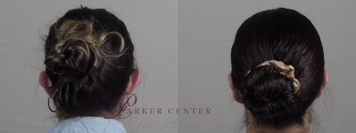 Ear Surgery Case 1269 Before & After Back | Paramus, NJ | Parker Center for Plastic Surgery
