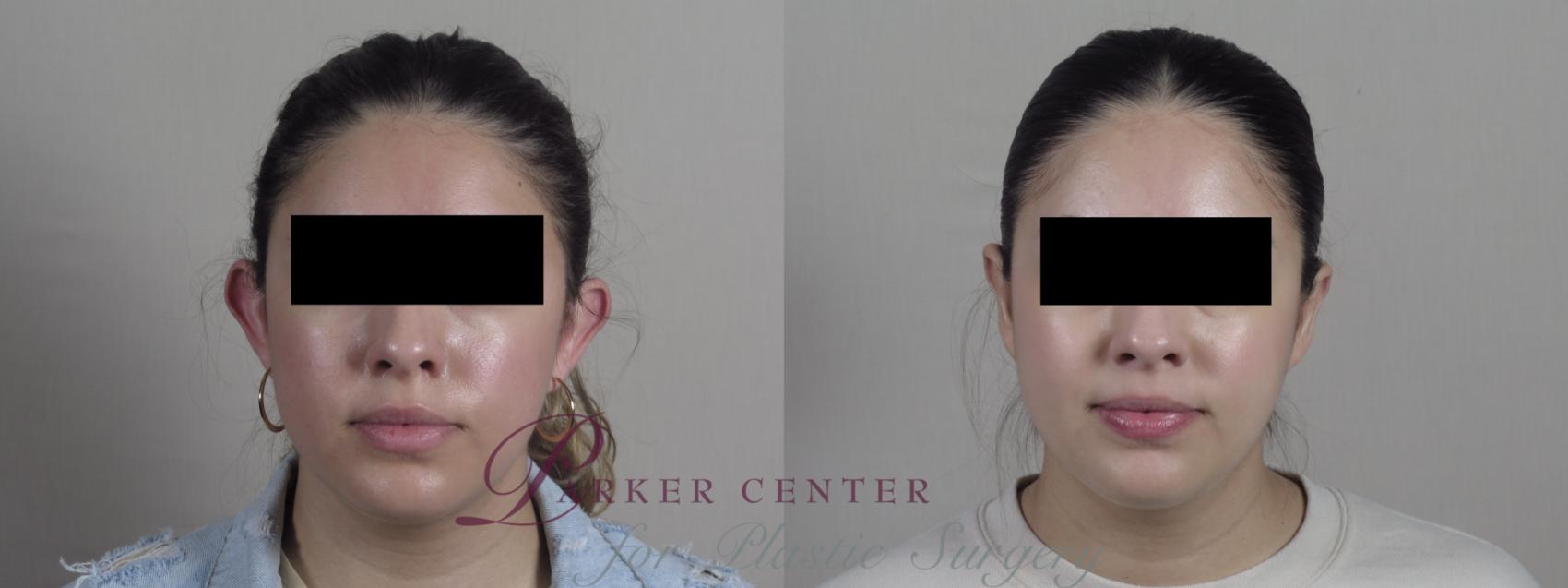Ear Surgery Case 1269 Before & After Front | Paramus, NJ | Parker Center for Plastic Surgery