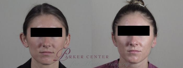 Otoplasty Case 1292 Before & After Front | Paramus, NJ | Parker Center for Plastic Surgery