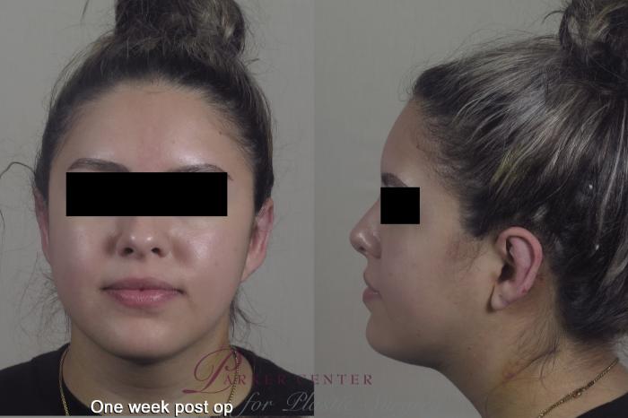 Otoplasty Case 1353 Before & After 1 week  | Paramus, New Jersey | Parker Center for Plastic Surgery