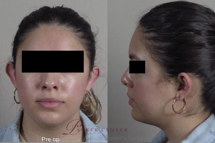 Otoplasty Case 1353 Before & After pre op  | Paramus, New Jersey | Parker Center for Plastic Surgery