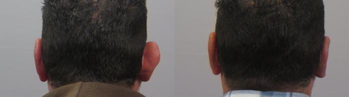 Otoplasty Case 1561 Before & After Back | Paramus, New Jersey | Parker Center for Plastic Surgery