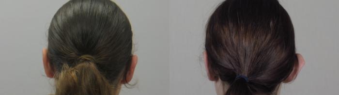 Otoplasty Case 1613 Before & After Back | Paramus, New Jersey | Parker Center for Plastic Surgery