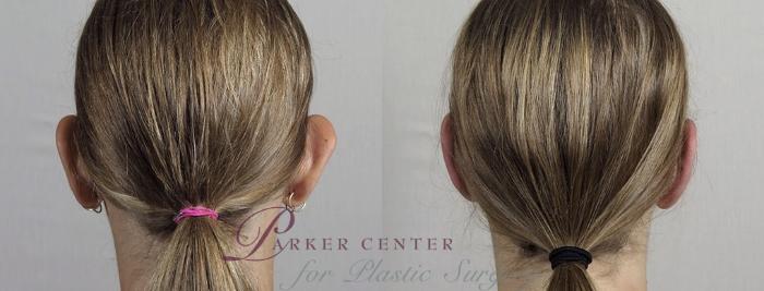 Otoplasty Case 897 Before & After View #4 | Paramus, NJ | Parker Center for Plastic Surgery