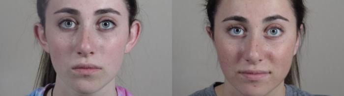 Otoplasty Case 985 Before & After Front | Paramus, New Jersey | Parker Center for Plastic Surgery