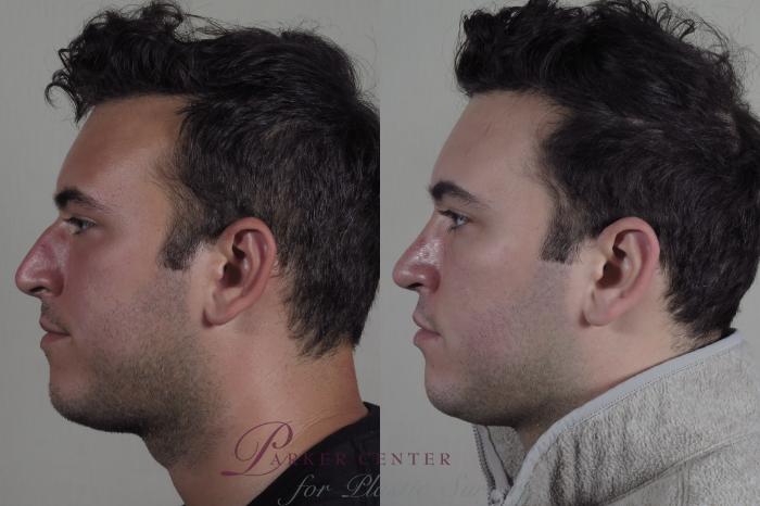 Rhinoplasty Case 1029 Before & After Right Side | Paramus, NJ | Parker Center for Plastic Surgery