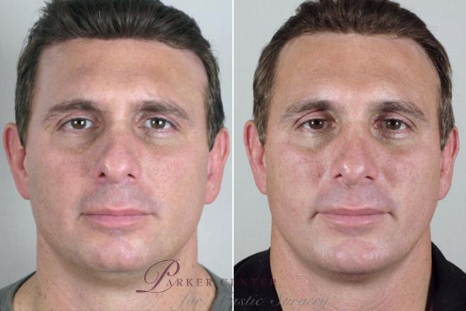 Rhinoplasty Case 116 Before & After View #1 | Paramus, NJ | Parker Center for Plastic Surgery