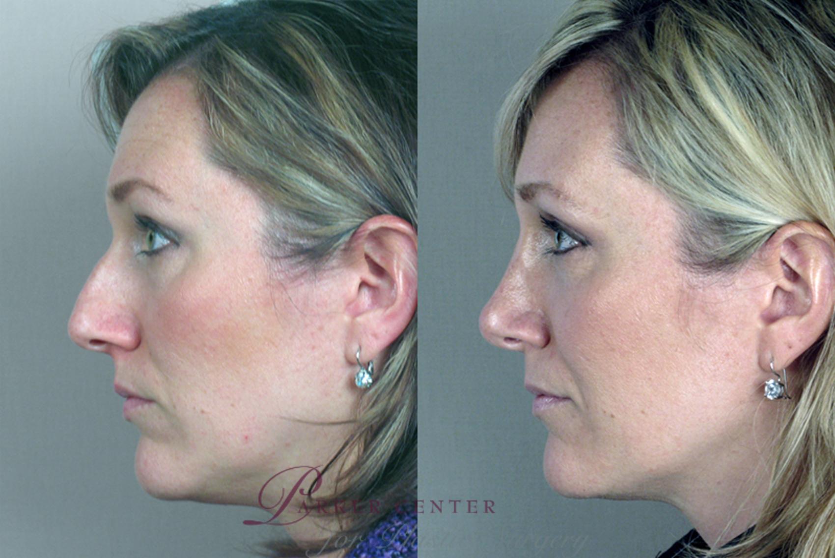 Rhinoplasty Case 117 Before & After View #2 | Paramus, NJ | Parker Center for Plastic Surgery
