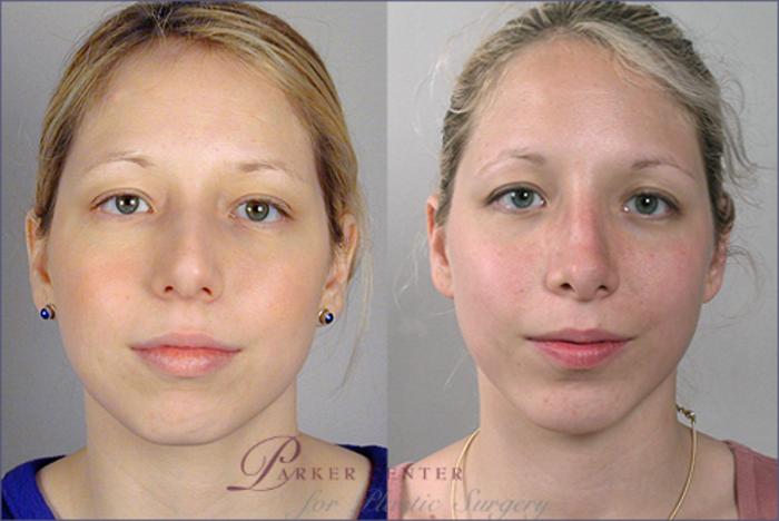 Cheek/Chin Implants Case 118 Before & After View #1 | Paramus, NJ | Parker Center for Plastic Surgery