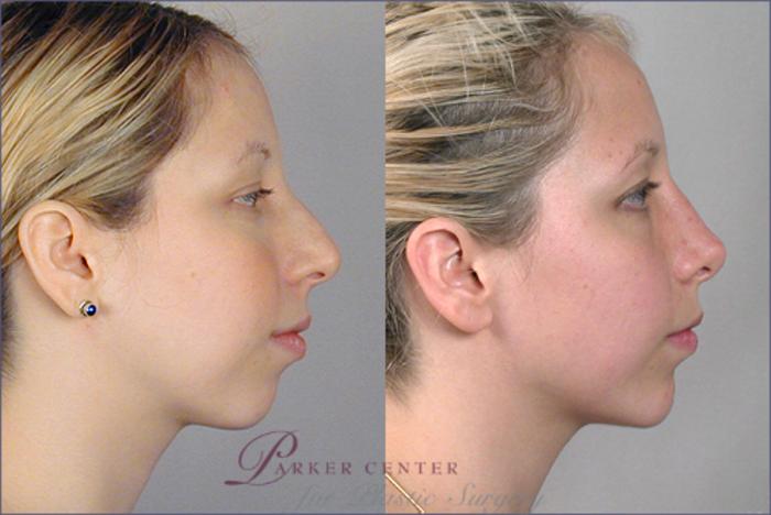 Cheek/Chin Implants Case 118 Before & After View #2 | Paramus, NJ | Parker Center for Plastic Surgery