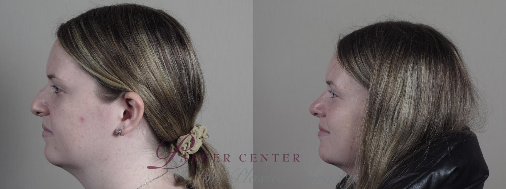 Rhinoplasty Case 1188 Before & After Left Side | Paramus, NJ | Parker Center for Plastic Surgery