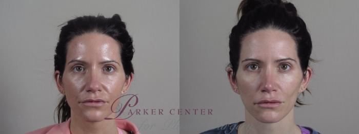 Rhinoplasty Case 1189 Before & After Front | Paramus, NJ | Parker Center for Plastic Surgery