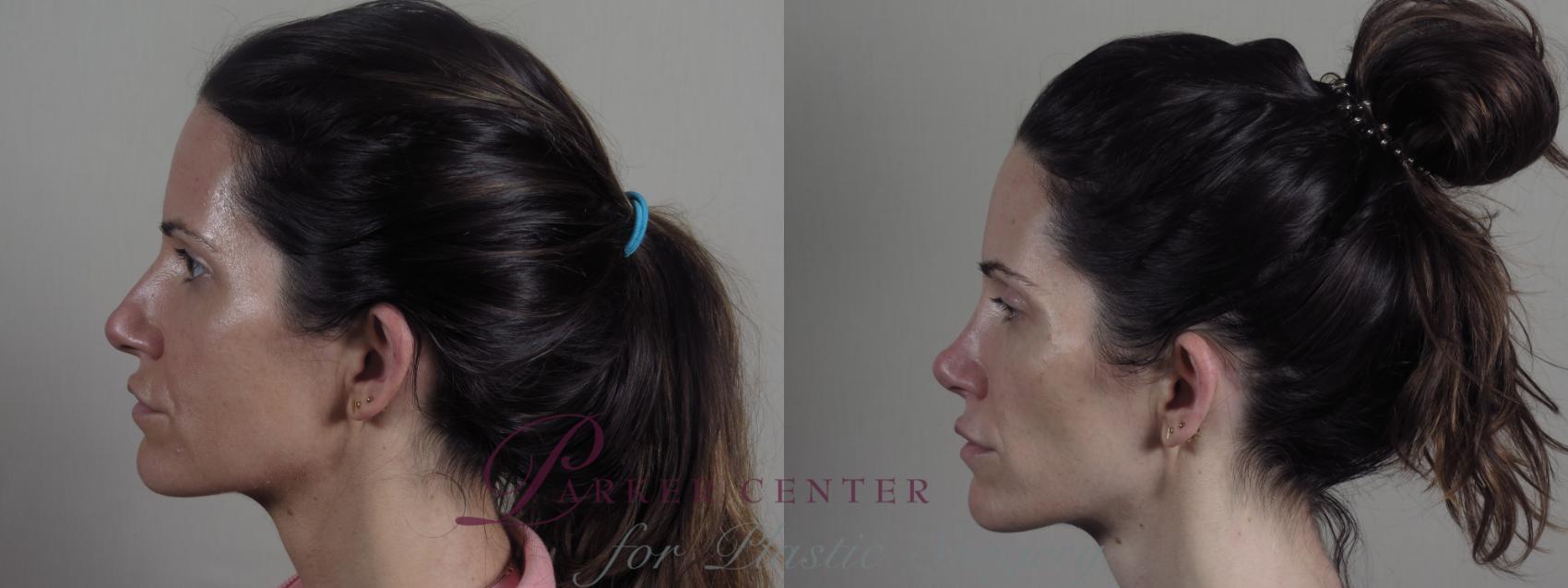 Rhinoplasty Case 1189 Before & After Left Side | Paramus, NJ | Parker Center for Plastic Surgery
