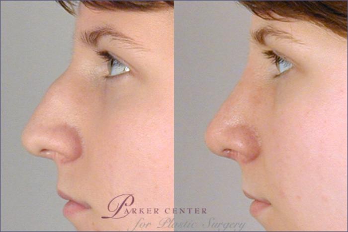 Rhinoplasty Case 119 Before & After View #2 | Paramus, New Jersey | Parker Center for Plastic Surgery
