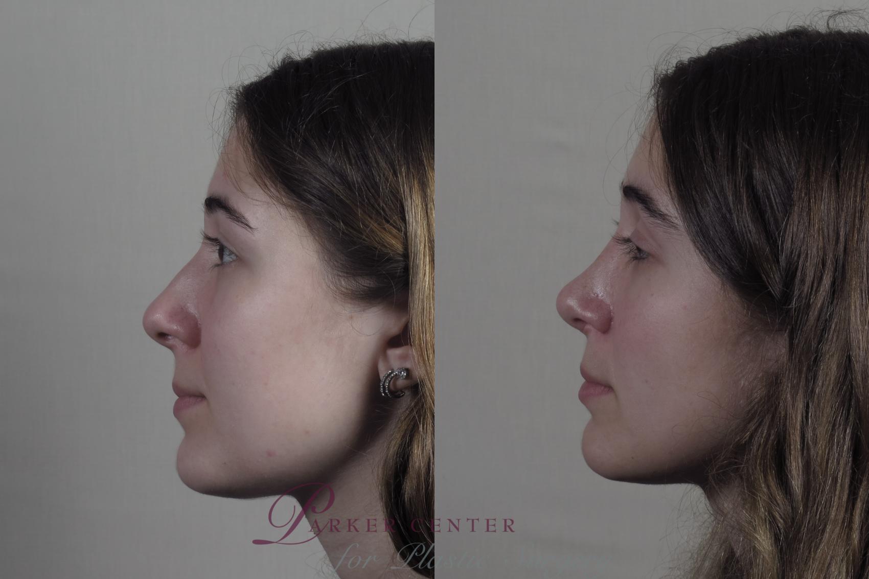 Rhinoplasty Case 1192 Before & After View #1  | Paramus, NJ | Parker Center for Plastic Surgery
