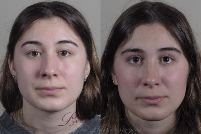 Rhinoplasty Case 1192 Before & After View #2 | Paramus, NJ | Parker Center for Plastic Surgery