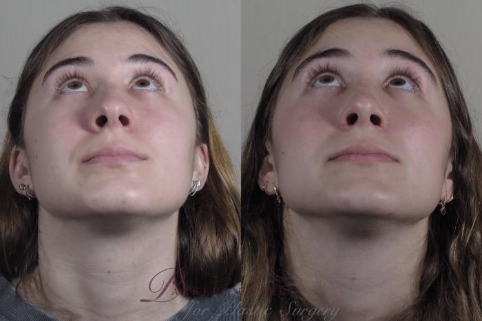Rhinoplasty Case 1192 Before & After View #3 | Paramus, NJ | Parker Center for Plastic Surgery