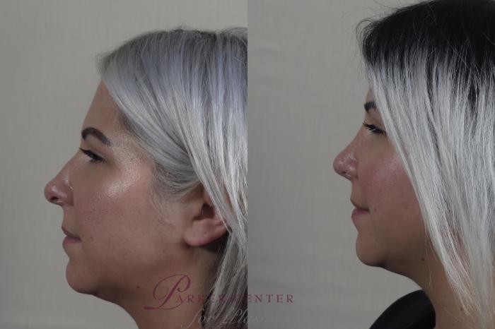 Rhinoplasty Case 1193 Before & After View #1  | Paramus, NJ | Parker Center for Plastic Surgery