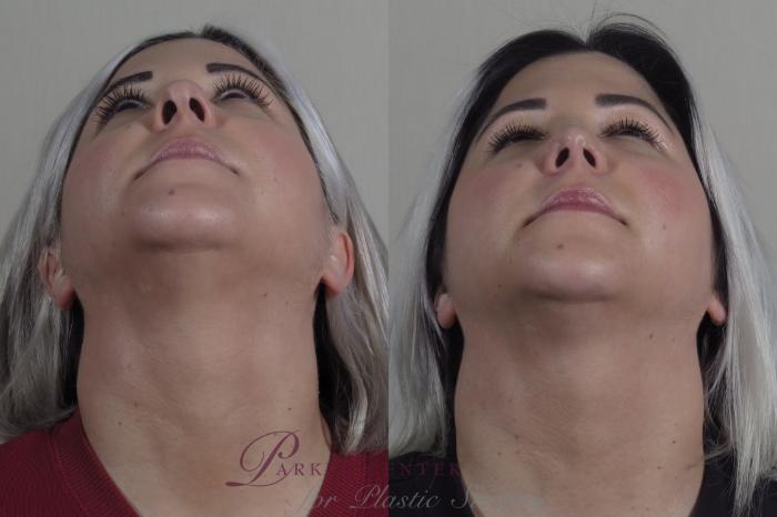 Rhinoplasty Case 1193 Before & After View #3 | Paramus, NJ | Parker Center for Plastic Surgery