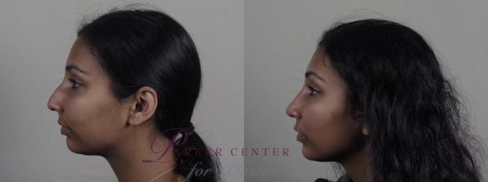 Rhinoplasty Case 1194 Before & After View #1  | Paramus, NJ | Parker Center for Plastic Surgery