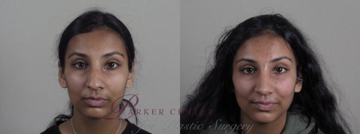 Rhinoplasty Case 1194 Before & After View #2 | Paramus, NJ | Parker Center for Plastic Surgery
