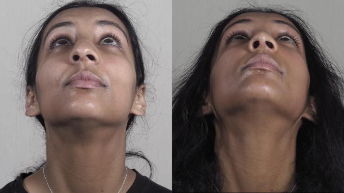 Rhinoplasty Case 1194 Before & After Worn's View | Paramus, New Jersey | Parker Center for Plastic Surgery