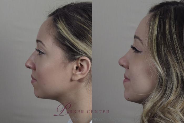 Rhinoplasty Case 1201 Before & After View #1  | Paramus, NJ | Parker Center for Plastic Surgery