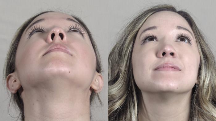 Rhinoplasty Case 1201 Before & After Worn's View  | Paramus, New Jersey | Parker Center for Plastic Surgery