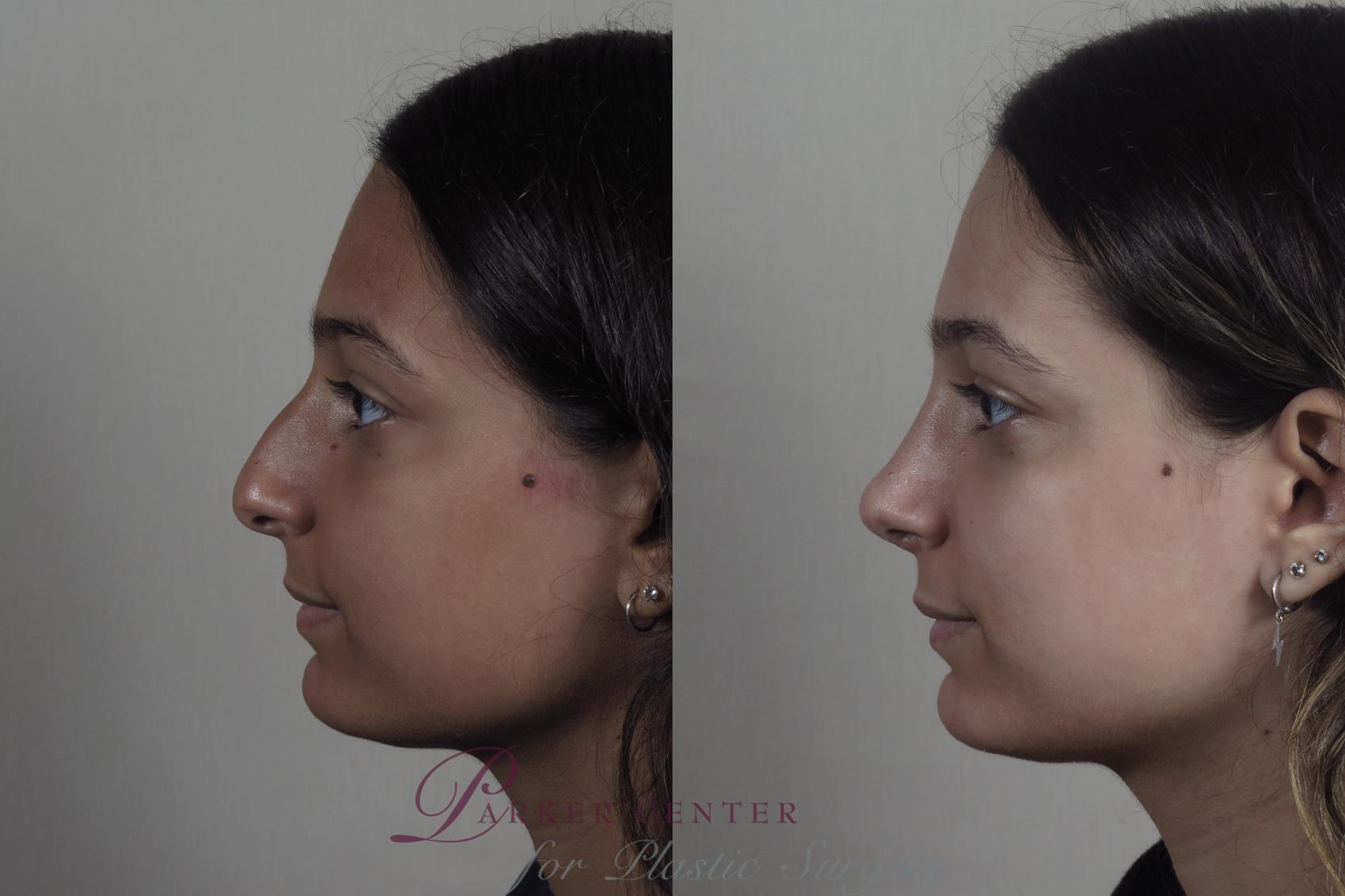 Rhinoplasty Case 1202 Before & After View #1  | Paramus, NJ | Parker Center for Plastic Surgery