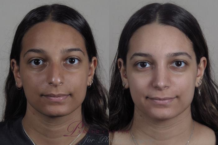 Rhinoplasty Case 1202 Before & After View #2 | Paramus, NJ | Parker Center for Plastic Surgery