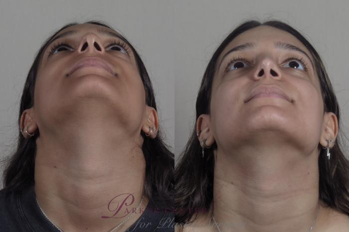 Rhinoplasty Case 1202 Before & After View #3 | Paramus, NJ | Parker Center for Plastic Surgery