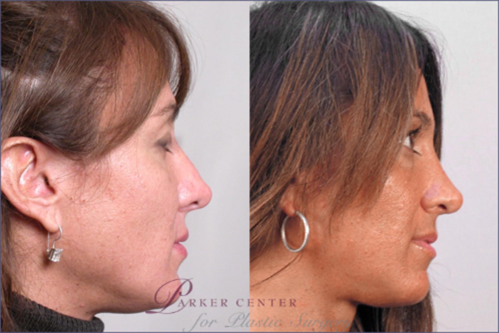 Rhinoplasty Case 121 Before & After View #2 | Paramus, NJ | Parker Center for Plastic Surgery