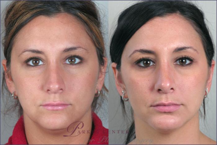 Rhinoplasty Case 122 Before & After View #1 | Paramus, NJ | Parker Center for Plastic Surgery