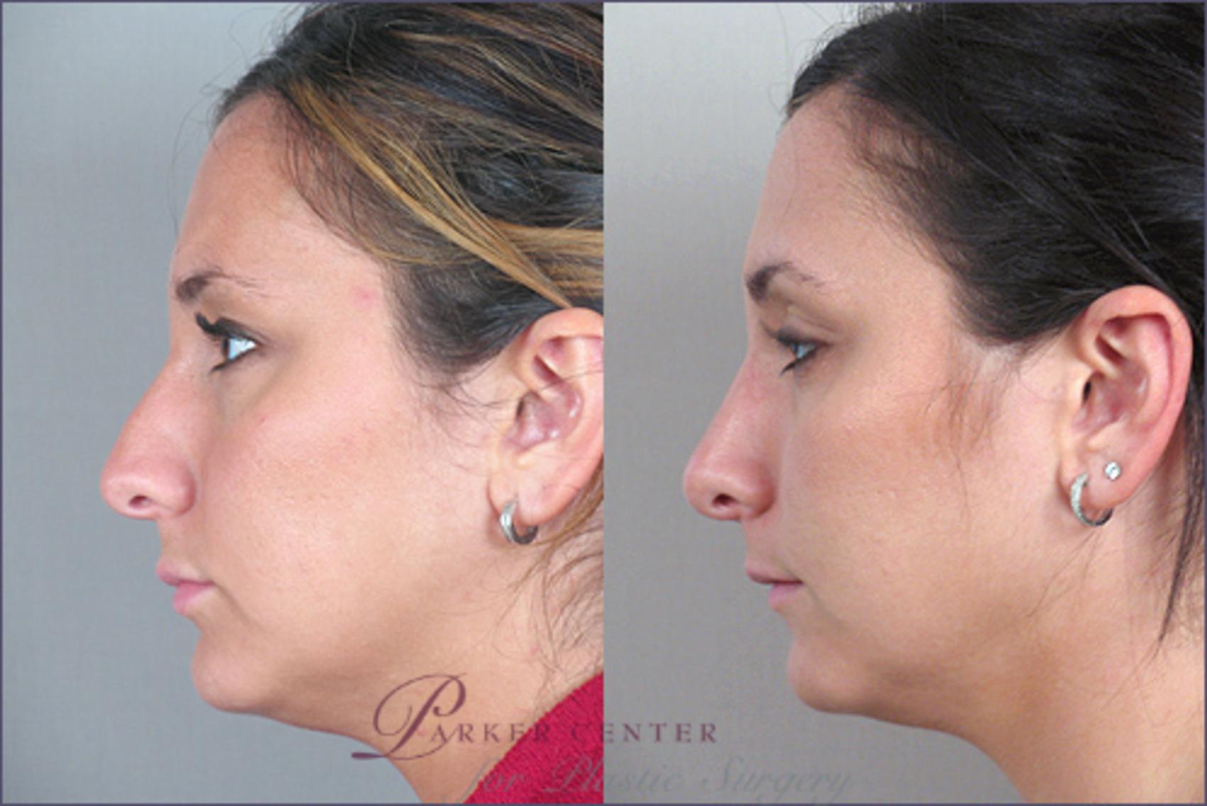 Rhinoplasty Case 122 Before & After View #2 | Paramus, NJ | Parker Center for Plastic Surgery