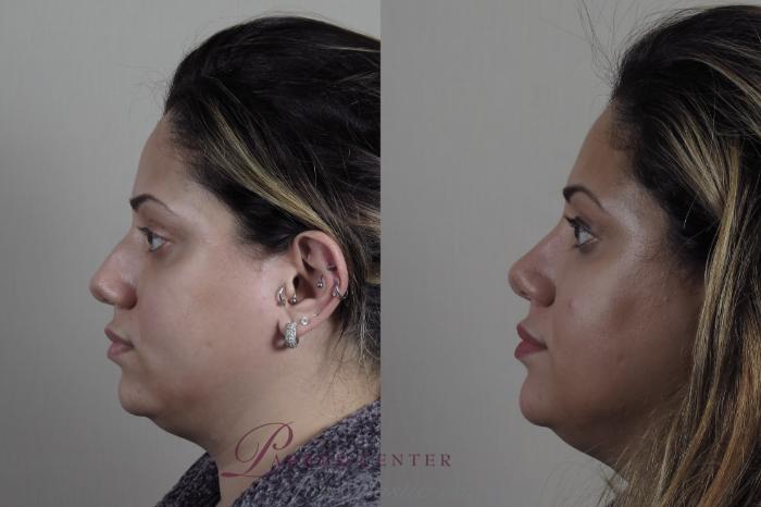 Rhinoplasty Case 1223 Before & After View #1  | Paramus, NJ | Parker Center for Plastic Surgery
