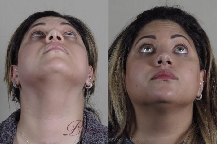 Rhinoplasty Case 1223 Before & After View #3 | Paramus, NJ | Parker Center for Plastic Surgery