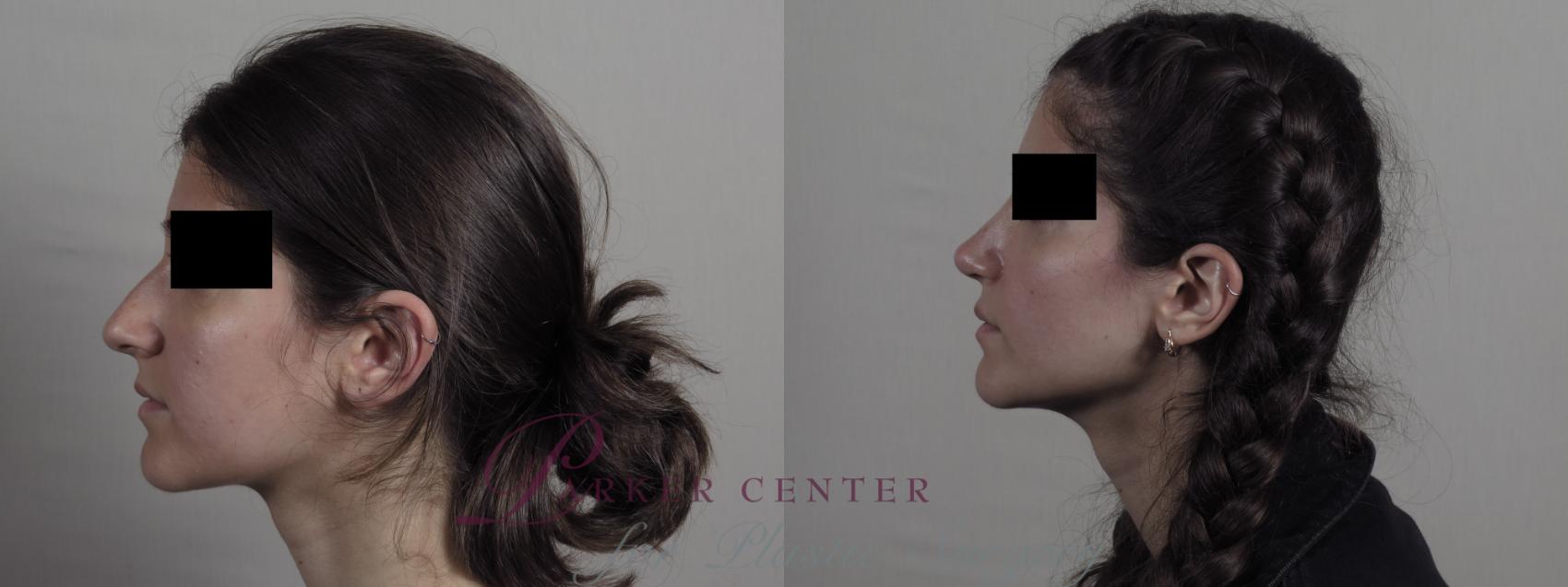 Rhinoplasty Case 1224 Before & After View #1  | Paramus, NJ | Parker Center for Plastic Surgery