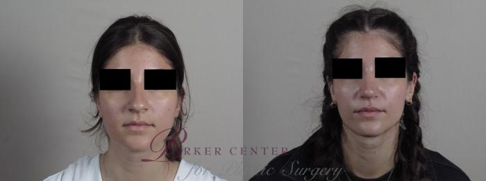 Rhinoplasty Case 1224 Before & After View #2 | Paramus, NJ | Parker Center for Plastic Surgery